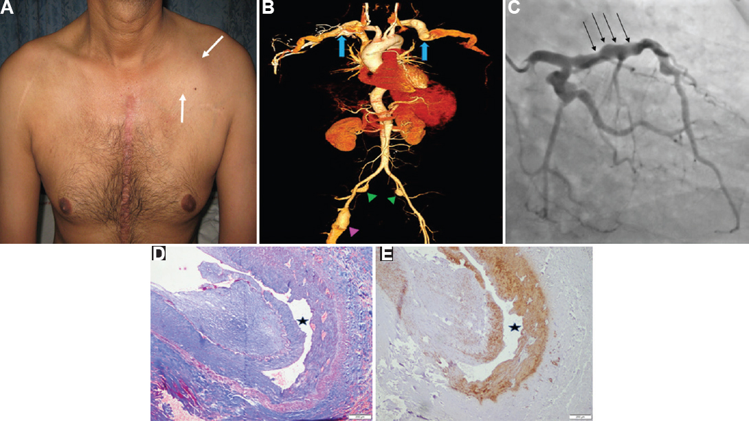 (A) Clinical photograph showing chest wall swelling (white arrow). (B) Computed tomography arteriography volume rendered image demonstrating aneurysmal bilateral subclavian (blue arrows), internal iliac (green arrowheads) and right femoral arteries (pink arrowhead). (C) Coronary angiogram demonstrates beaded appearance of left coronary artery (black arrows). (D) Histopathological examination of the excised brachial aneurysm (H and E, ×200) and (E) smooth muscle actin (IHC, ×200), respectively, showing pathognomonic dissection in the arterial media (black star).